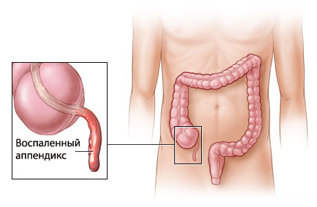 Аппендицит Аппендицит